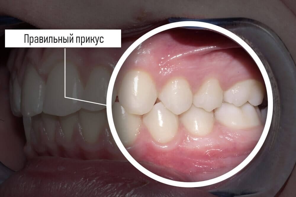 правильный прикус - здоровое смыкание зубов не требующее исправления